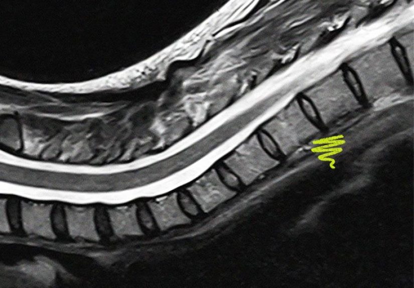 Adrenoleukodystrophy: Types, symptoms, inheritance, and more