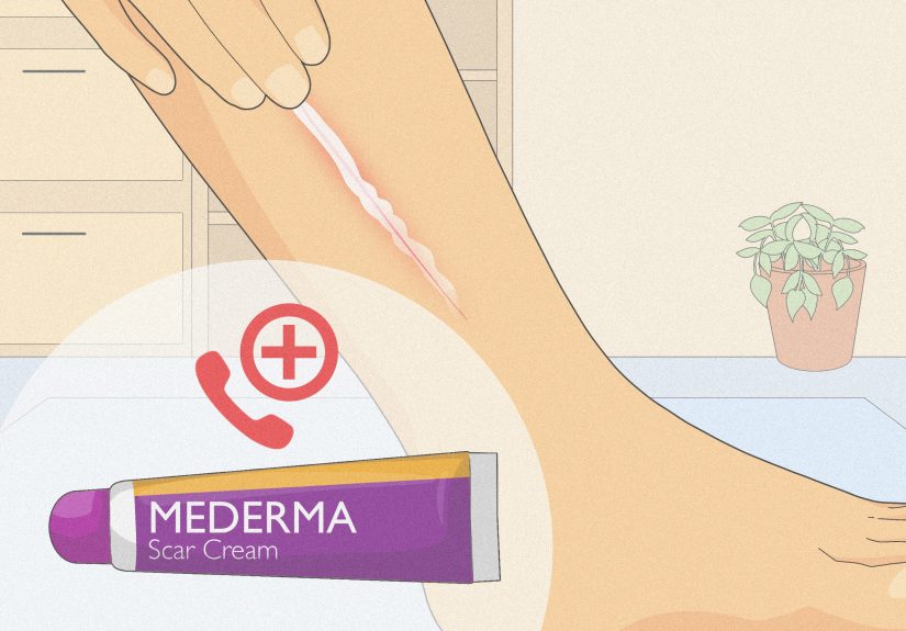 How to Remove Steri Strips: 9 Steps