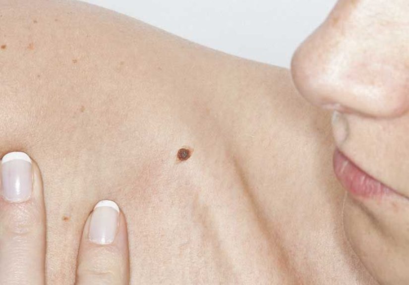 Itchy Mole: Causes, Treatment, Symptoms and More