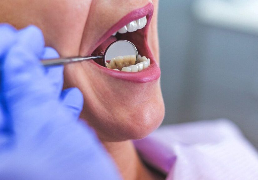 Abscessed Tooth: Types, Symptoms, Causes, Treatment, and Pictures
