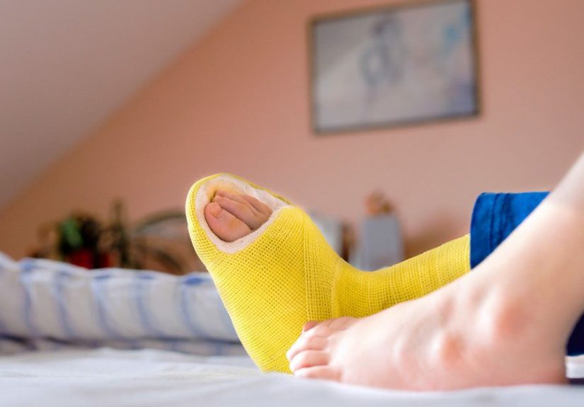 Fiberglass Cast: Why Fiberglass and How to Care for It