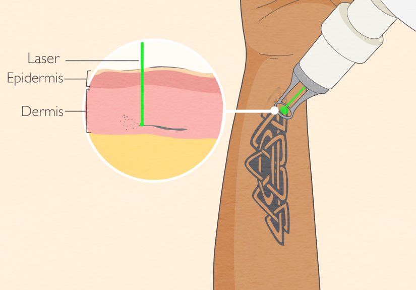 How Many Sessions to Remove a Tattoo? Here's the Average