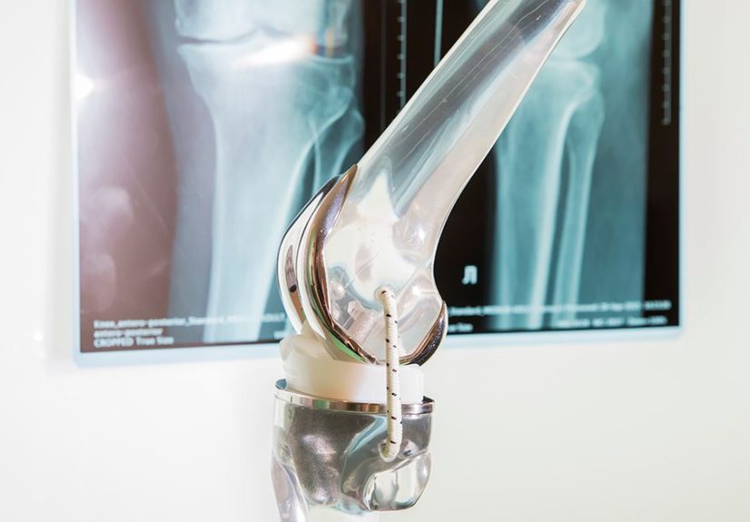 Knee Replacement Implants: How to Choose What’s Right for You