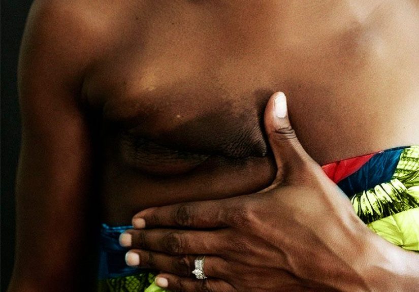 Mastectomy scars: Treatment options and what to expect