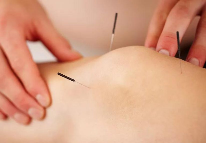 Need Pain Relief? Try Acupuncture Instead of Opioids