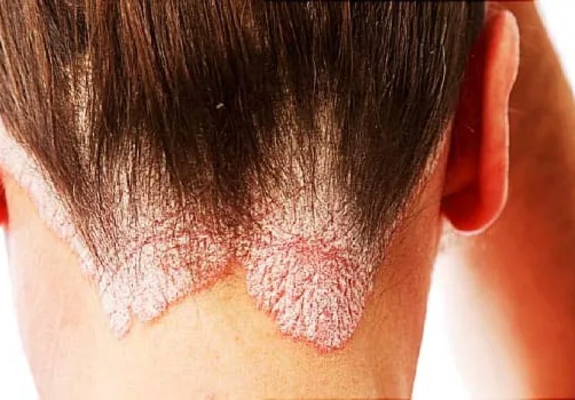 Scalp Psoriasis: Pictures, Symptoms, Causes, Treatment