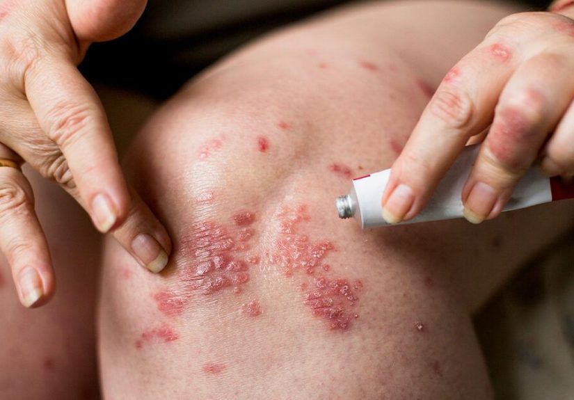 Steroid Cream for Psoriasis: Types, How to Use, Side Effects