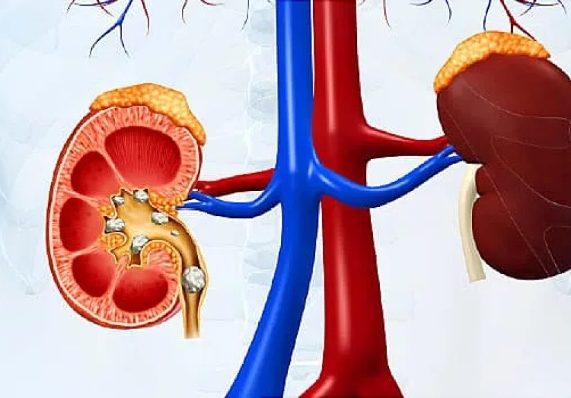 7 Things to Know About Kidney Stones