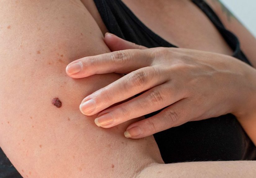 Basal Cell Carcinoma vs. Squamous Cell Carcinoma