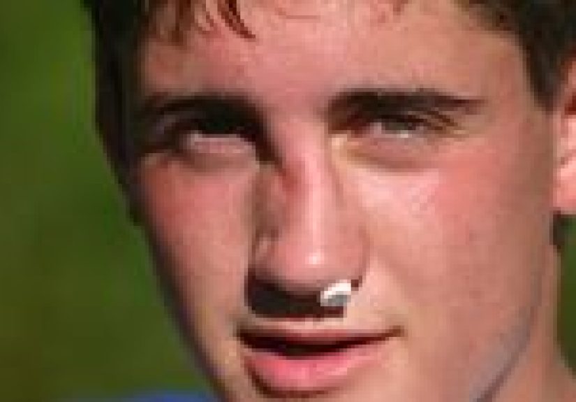 Broken Nose: Symptoms, Treatment, and Prevention