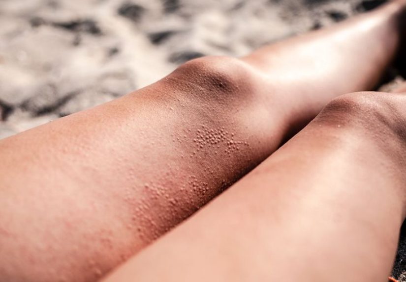 Is the Sun Good for Eczema? Your FAQs Answered