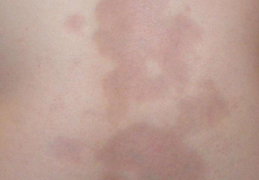 Morphea: Symptoms, Causes, and Treatment