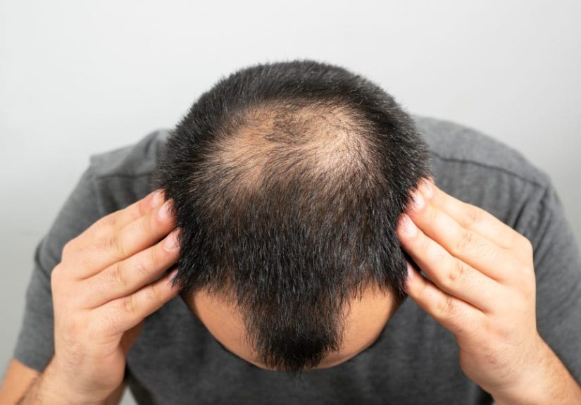 New Hair Growth Drug PP405 Could Reverse Baldness: Details, Tests