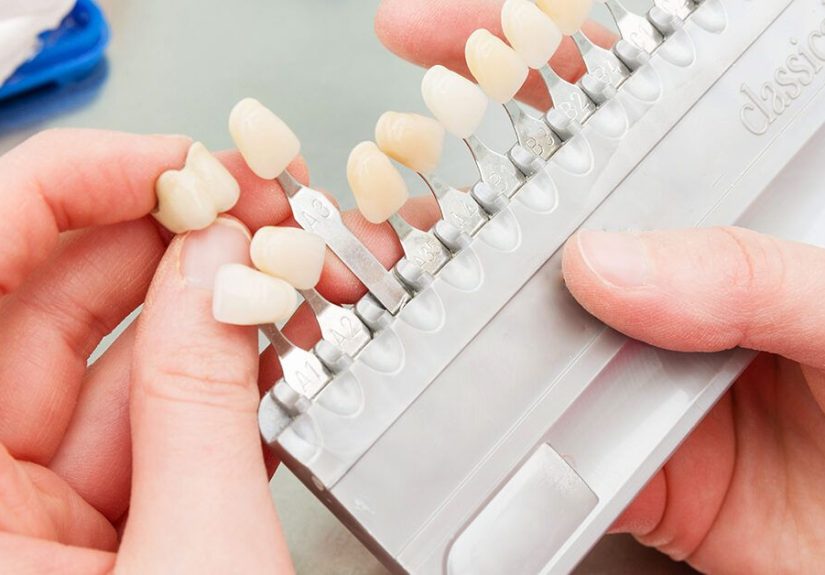 No-Prep Veneers: Benefits, Precautions, and Alternative Treatments