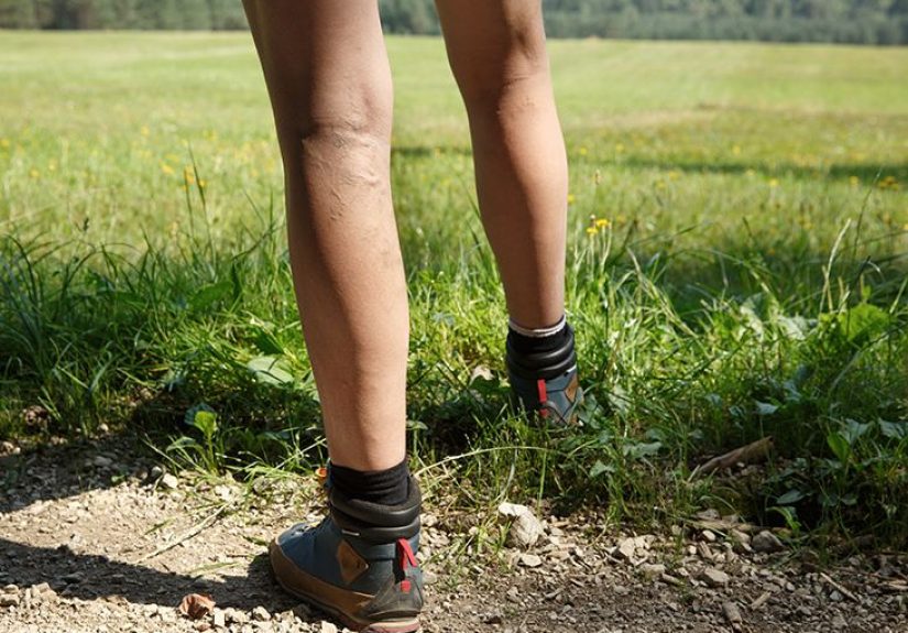 Phlebitis: Definition, symptoms, treatment, and more