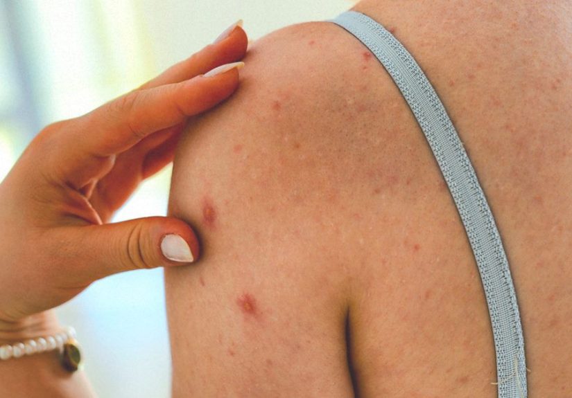 Steroid Acne: Causes and Treatment