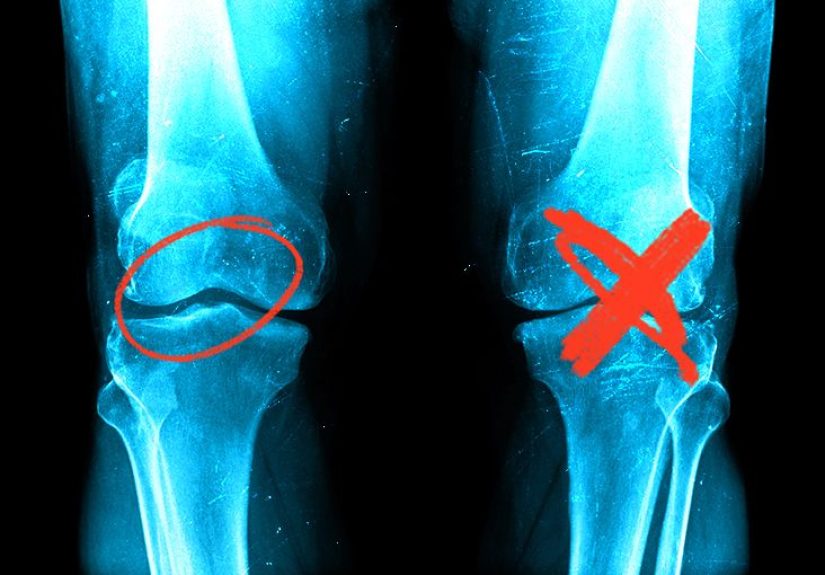 Stiff joints: Why they happen and how to get rid of them