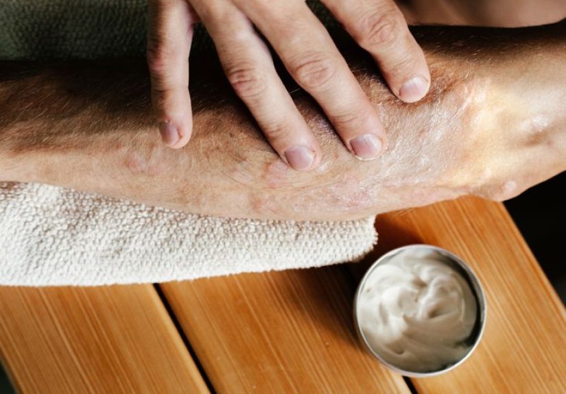 Tratamiento de la psoriasis: Por qué cambiar de medicación