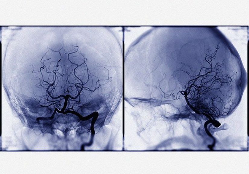 What can cause a brain aneurysm to rupture?