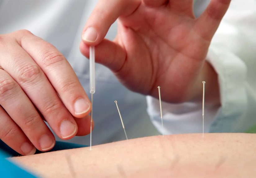 4 Alternative and Complementary Therapies for Ulcerative Colitis
