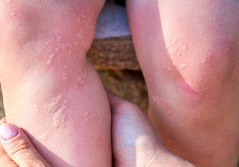 Breaking Out in Hives for No Apparent Reason