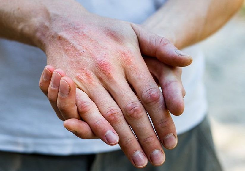 Dermatitis: Types, Symptoms, and Treatment