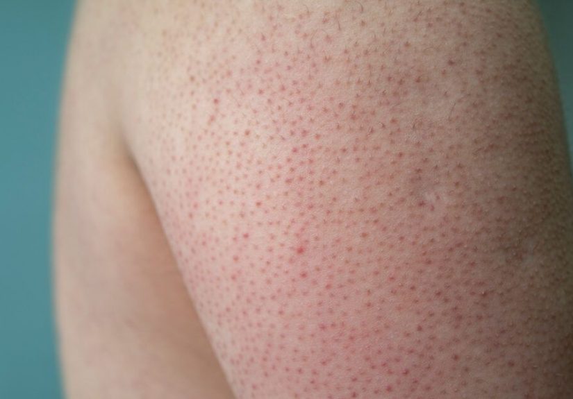 Keratosis Pilaris Treatment: From Creams to Lasers