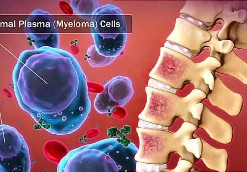 Visual Guide to Multiple Myeloma